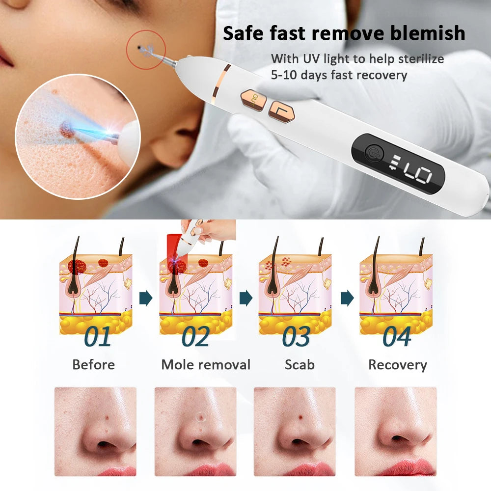 Plasma Pen Mole & Skin Tag Remover Device