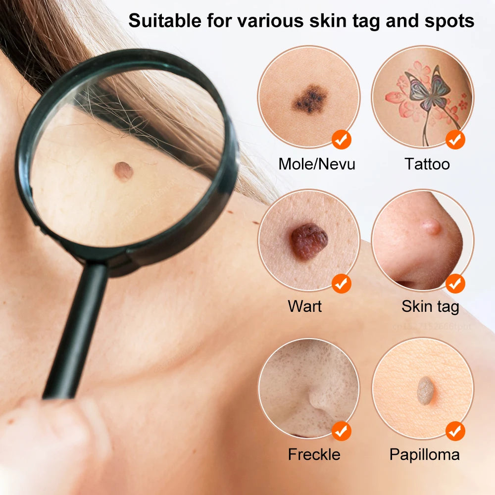 Plasma Pen Mole & Skin Tag Remover Device