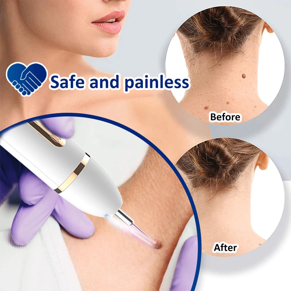 Plasma Pen Mole & Skin Tag Remover Device