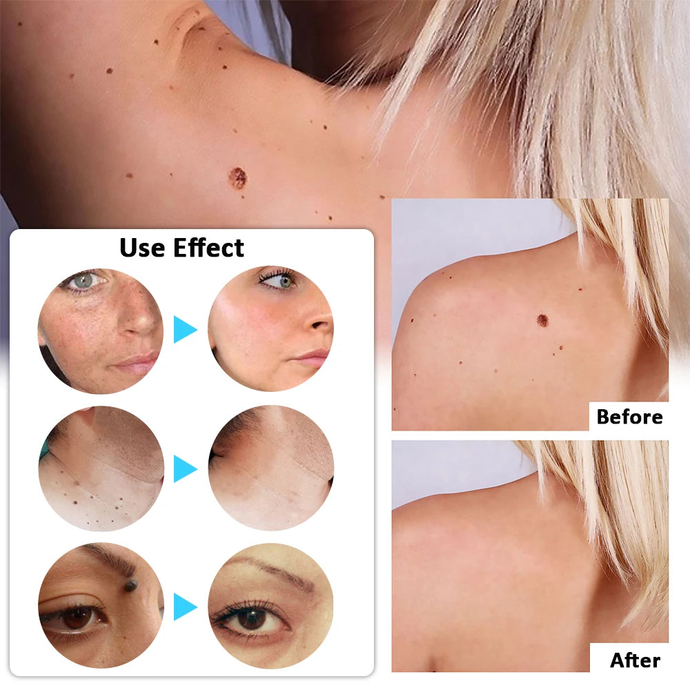Plasma Pen Mole & Skin Tag Remover Device